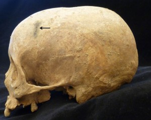 Cranium of adult female with green oxide stain from a shroud pin (arrow)